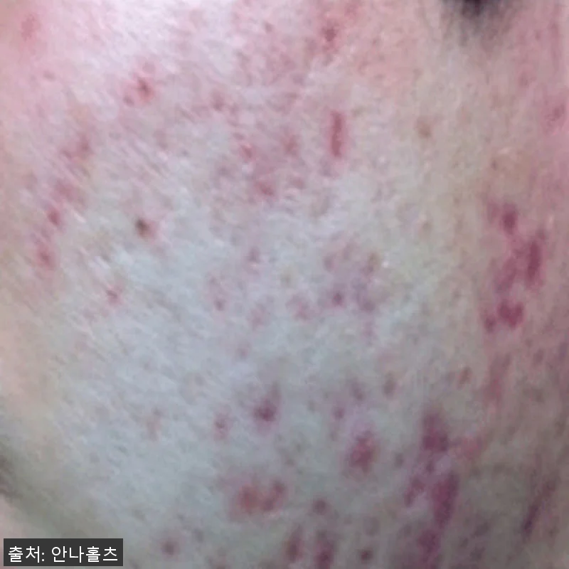 안나홀츠 얼굴 색소침착 바르는 비타민 관련 이미지 1
