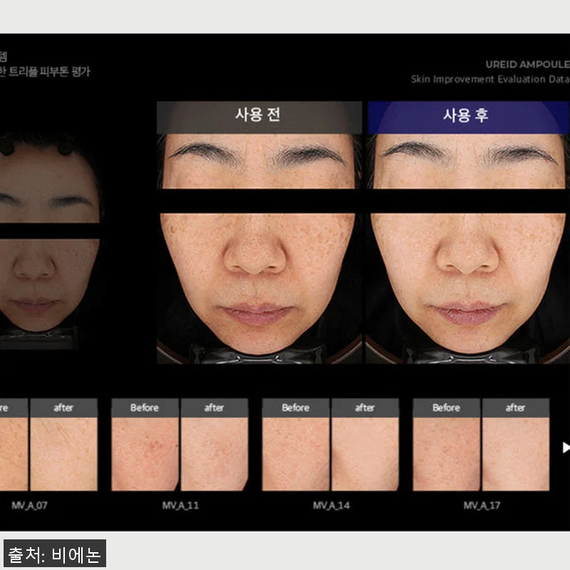 비에논 우레이드 기미앰플 사용후기: 관련 이미지 1